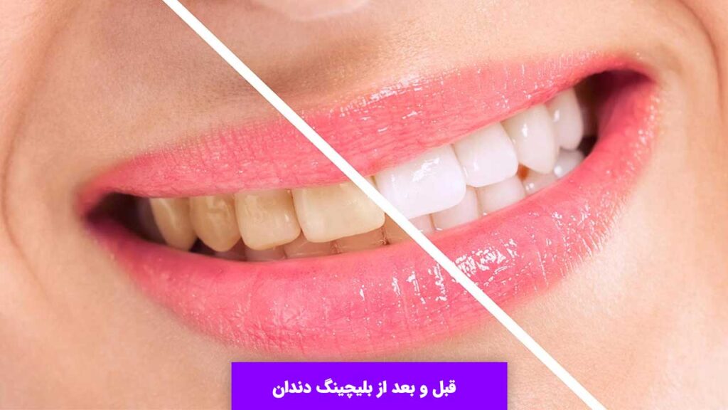 قبل و بعد از بلیچینگ دندان شما را شگفت زده خواهد کرد.