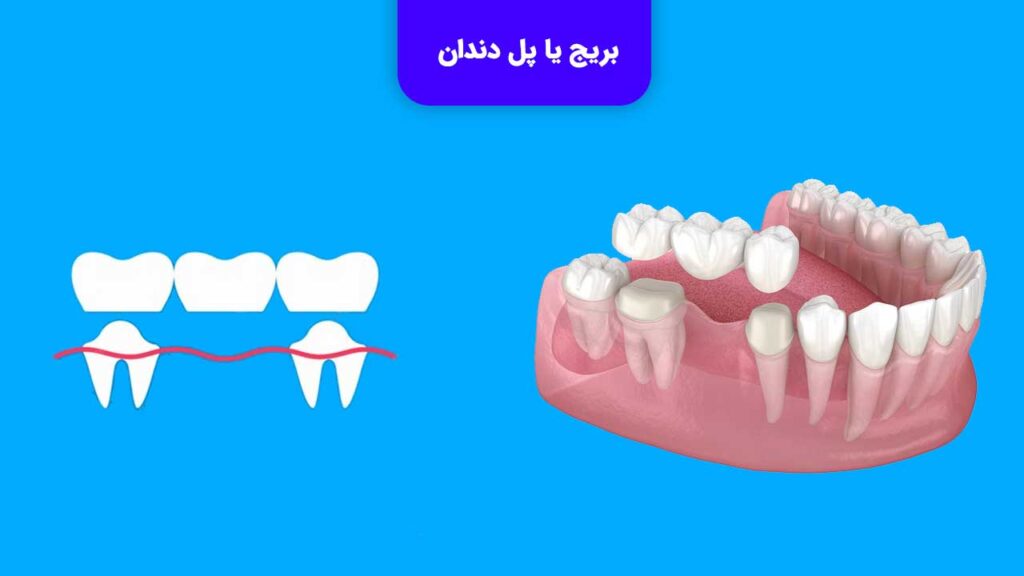 بریج یا پل دندان یکی از انواع پروتز دندان ثابت می باشد.