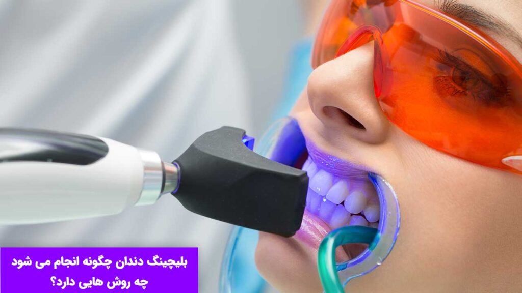 بلیچینگ دندان به 3 روش انجام می شود.