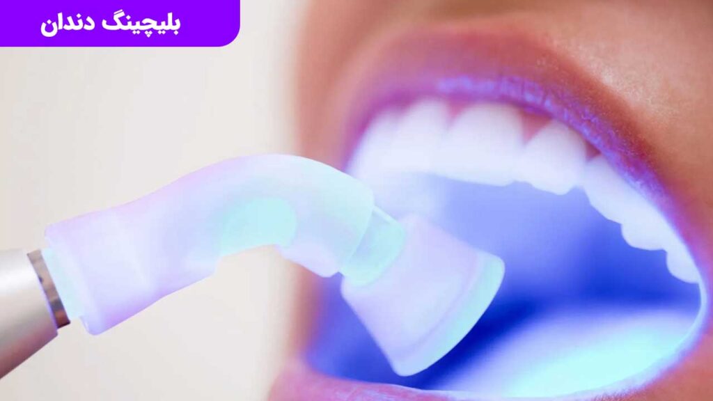 بلیچینگ دندان یکی از راه های سفید کردن دندان