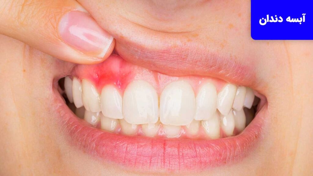 آبسه دندان دلایلی از دندان درد