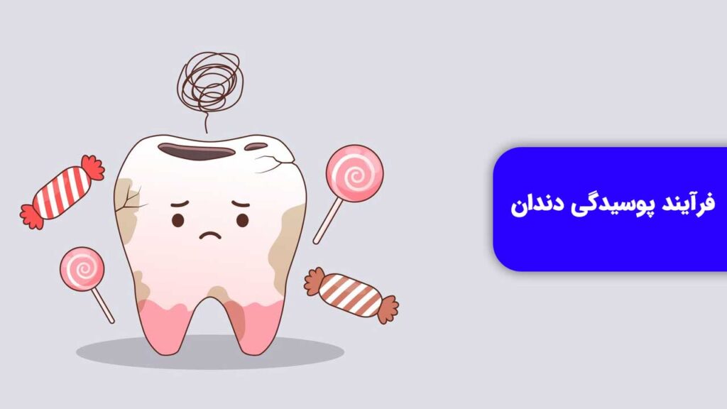 فرآیند پوسیدگی دندان